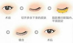 眼袋术后增生怎么办 可以不手术祛眼袋吗
