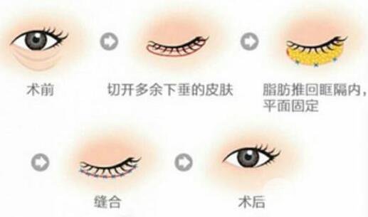 眼袋术后增生怎么办 可以不手术祛眼袋吗