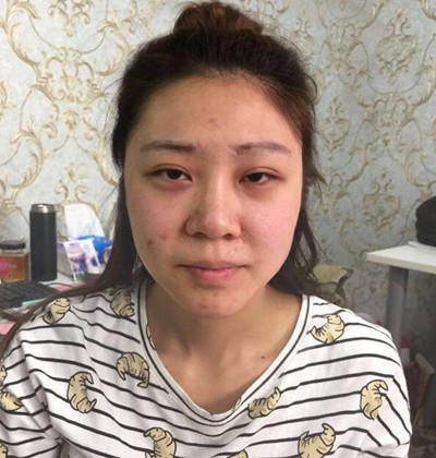 隆鼻整形+埋埋蛋白线.提升+自体脂肪全脸填充术后改头换面！