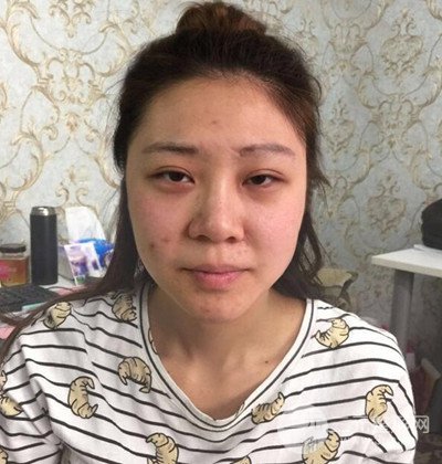 隆鼻整形+埋埋蛋白线.提升+自体脂肪全脸填充术后改头换面！
