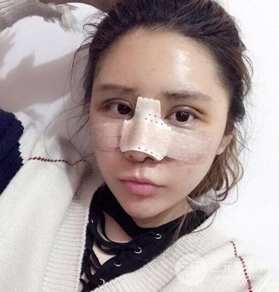 隆鼻整形+埋埋蛋白线.提升+自体脂肪全脸填充术后改头换面！