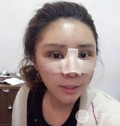 隆鼻整形+埋埋蛋白线.提升+自体脂肪全脸填充术后改头换面！