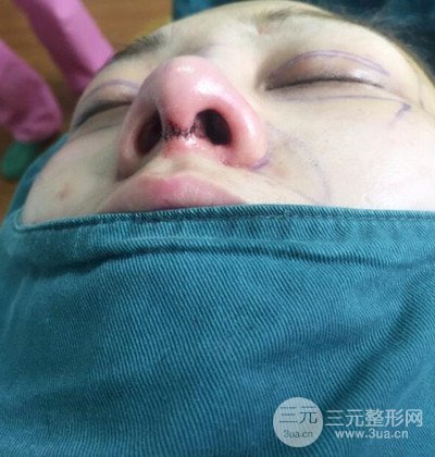 隆鼻整形+埋埋蛋白线.提升+自体脂肪全脸填充术后改头换面！