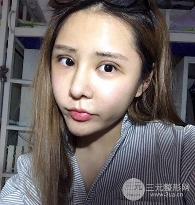 隆鼻整形+埋埋蛋白线.提升+自体脂肪全脸填充术后改头换面！