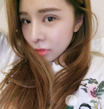 隆鼻整形+埋埋蛋白线.提升+自体脂肪全脸填充术后改头换面！