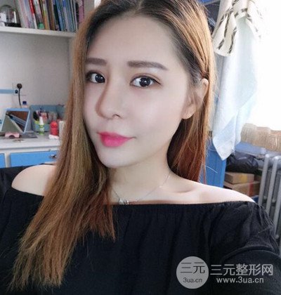 隆鼻整形+埋埋蛋白线.提升+自体脂肪全脸填充术后改头换面！