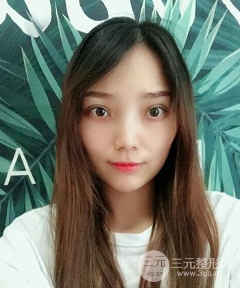 双眼皮失败修复手术日记分享，改变双眼皮不对称