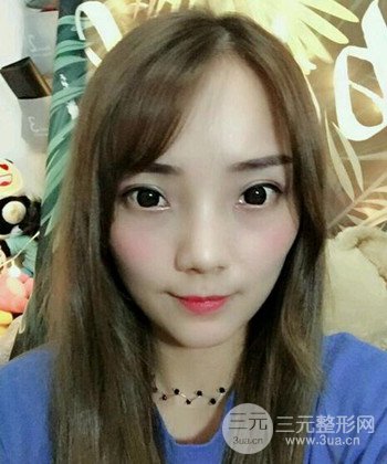 双眼皮失败修复手术日记分享，改变双眼皮不对称