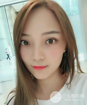 双眼皮失败修复手术日记分享，改变双眼皮不对称