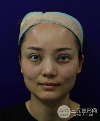 双眼皮失败修复手术日记分享，改变双眼皮不对称