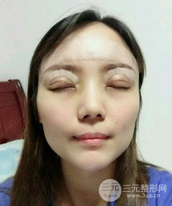 双眼皮失败修复手术日记分享，改变双眼皮不对称