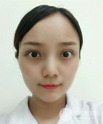 双眼皮失败修复手术日记分享，改变双眼皮不对称