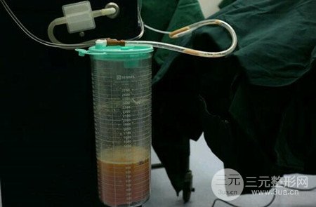 梨型身材做了大腿吸脂之后果超明X，吸脂恢复过程分享