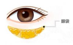 去眼袋降低风险吗?祛眼袋手术安不降低风险?