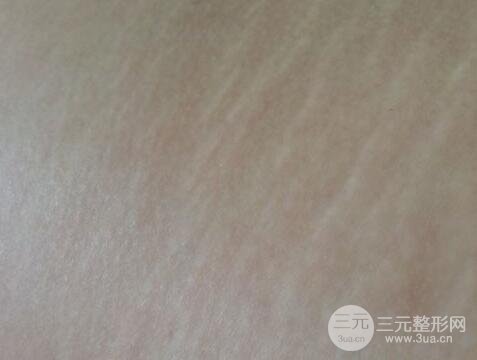 肥胖纹怎么消除?有哪些好的方法?