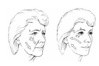 锯齿.线除皱有吗？果怎么样？