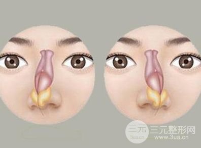 歪鼻矫正术一般需要多少钱 价格？