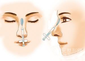 玻尿酸隆鼻后鼻子变宽怎么办？
