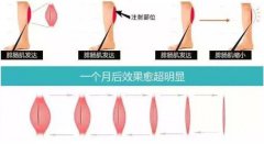 打注射瘦腿要多少钱?注射注射瘦腿的价格?