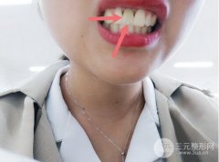 做全口义齿多少钱？制作流程是怎样的？