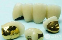 钯金烤瓷牙怎么样?如何选择烤瓷牙?