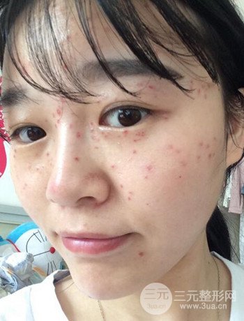 北京激光去雀斑真实案例分享，纯素颜无滤镜果图