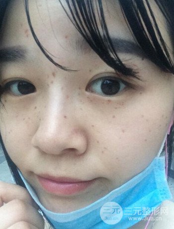 北京激光去雀斑真实案例分享，纯素颜无滤镜果图