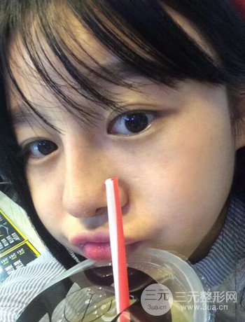 北京激光去雀斑真实案例分享，纯素颜无滤镜果图