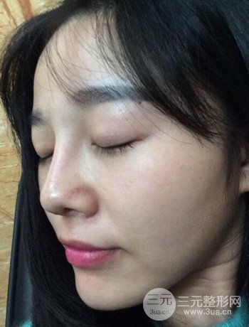 北京激光去雀斑真实案例分享，纯素颜无滤镜果图