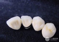 各种烤瓷牙价格？烤瓷牙多少钱?