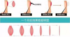 注射瘦腿有吗?瘦小腿的方法?