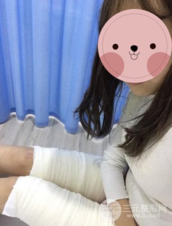 吸脂瘦大腿手术经历分享，纤细双腿不再是梦