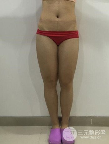 吸脂瘦大腿手术经历分享，纤细双腿不再是梦