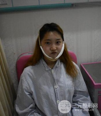 终于做了下颌角整形，分享术后恢复果