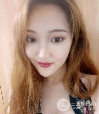 终于做了下颌角整形，分享术后恢复果