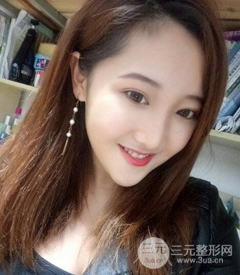 终于做了下颌角整形，分享术后恢复果