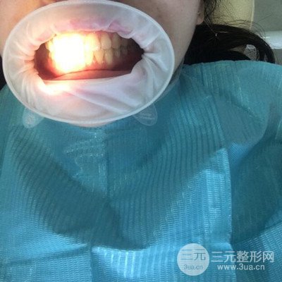 做了牙齿冷光美白果很棒，绽放美丽笑容