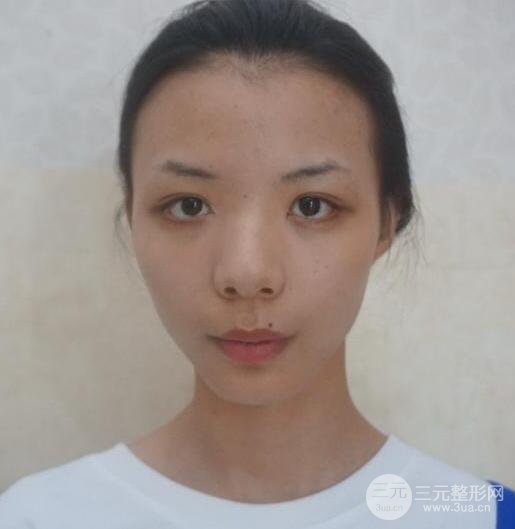 银川崔大夫博士丽朱杰硅胶隆鼻恢复图，轻松get精致脸