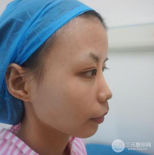 银川崔大夫博士丽朱杰硅胶隆鼻恢复图，轻松get精致脸