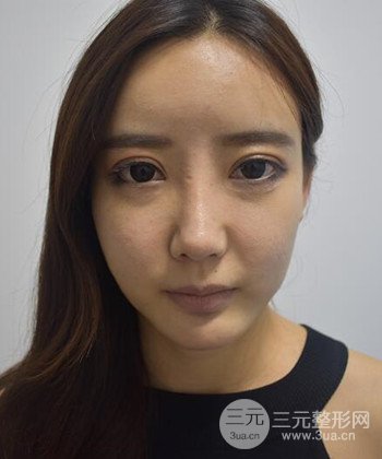 全脸自体脂肪填充手术日记分享，改良脸型年轻十岁