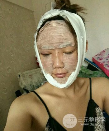 全脸自体脂肪填充手术日记分享，改良脸型年轻十岁