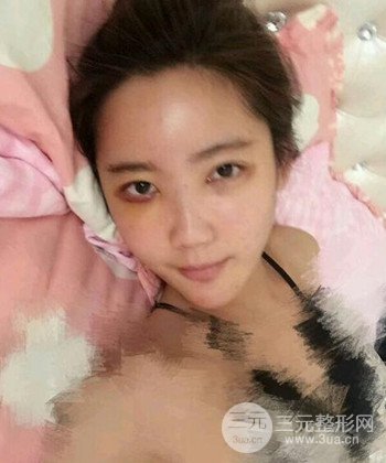 全脸自体脂肪填充手术日记分享，改良脸型年轻十岁