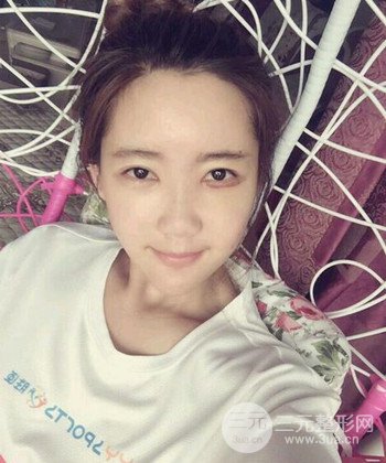 全脸自体脂肪填充手术日记分享，改良脸型年轻十岁