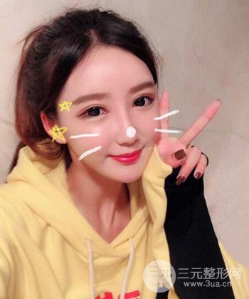 全脸自体脂肪填充手术日记分享，改良脸型年轻十岁