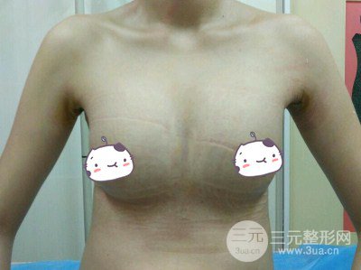 平胸妹做了假体隆胸果分享，丰满身材不是梦