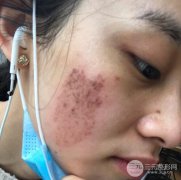 激光缓解去咖啡斑的果好不好？真实分享~