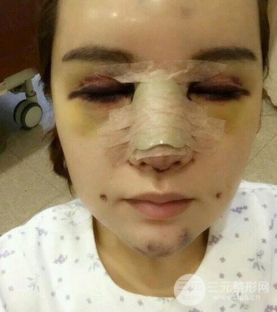 隆鼻整形手术个人经历分享，精致小翘鼻不是梦