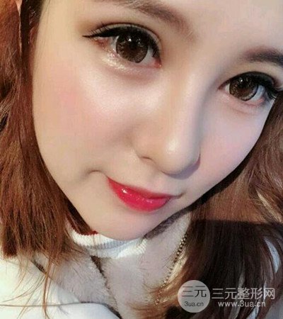 隆鼻整形手术个人经历分享，精致小翘鼻不是梦