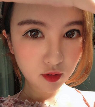 隆鼻整形手术个人经历分享，精致小翘鼻不是梦