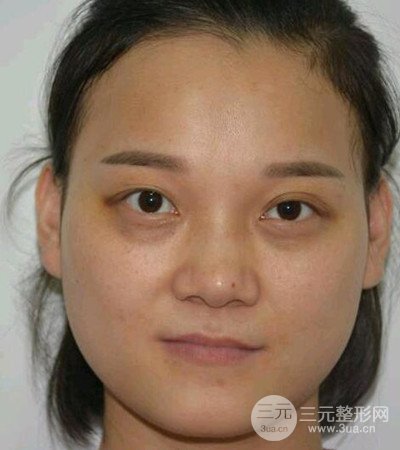 切开双眼皮术后改良双眼不对称，恢复果图分享